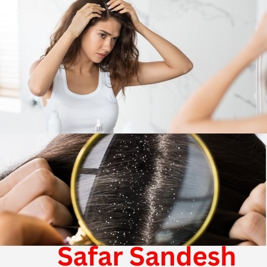 How to remove dandruff from hair.

