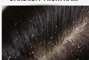 How to remove dandruff from hair.